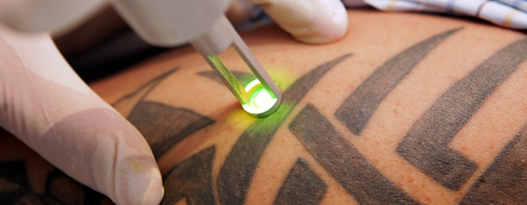 Удаление татуировки с лазером