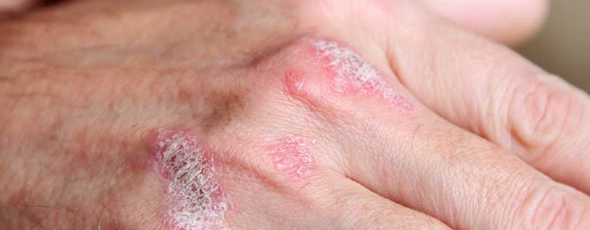 TREATMENT OF PSORIASIS