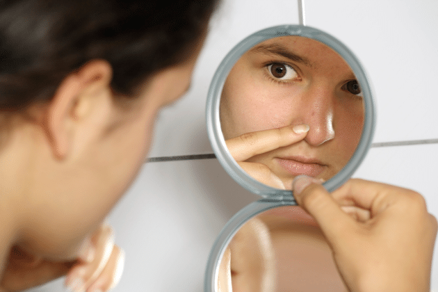Acne causes phobia in teenagers