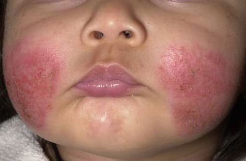Atopische Dermatitis bei Säuglingen und Kindern