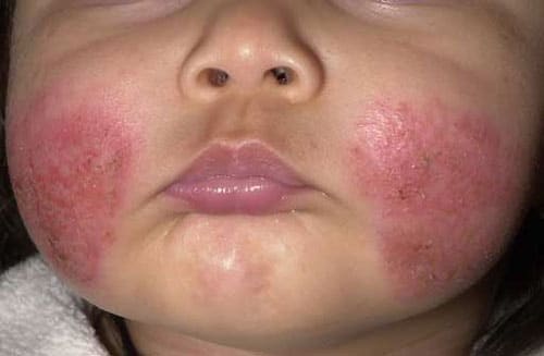 Atopic dermatitis in infants and children