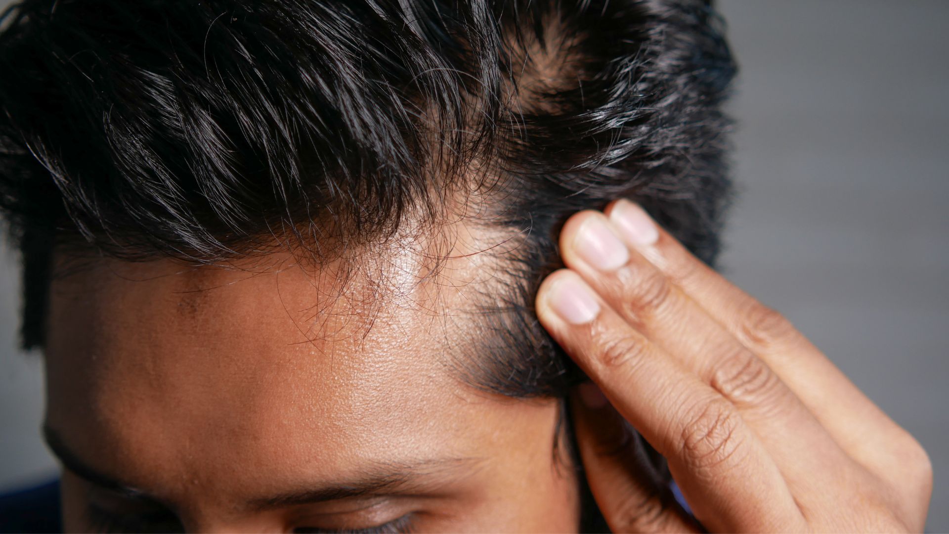 Лечение выпадения волос стволовыми клетками