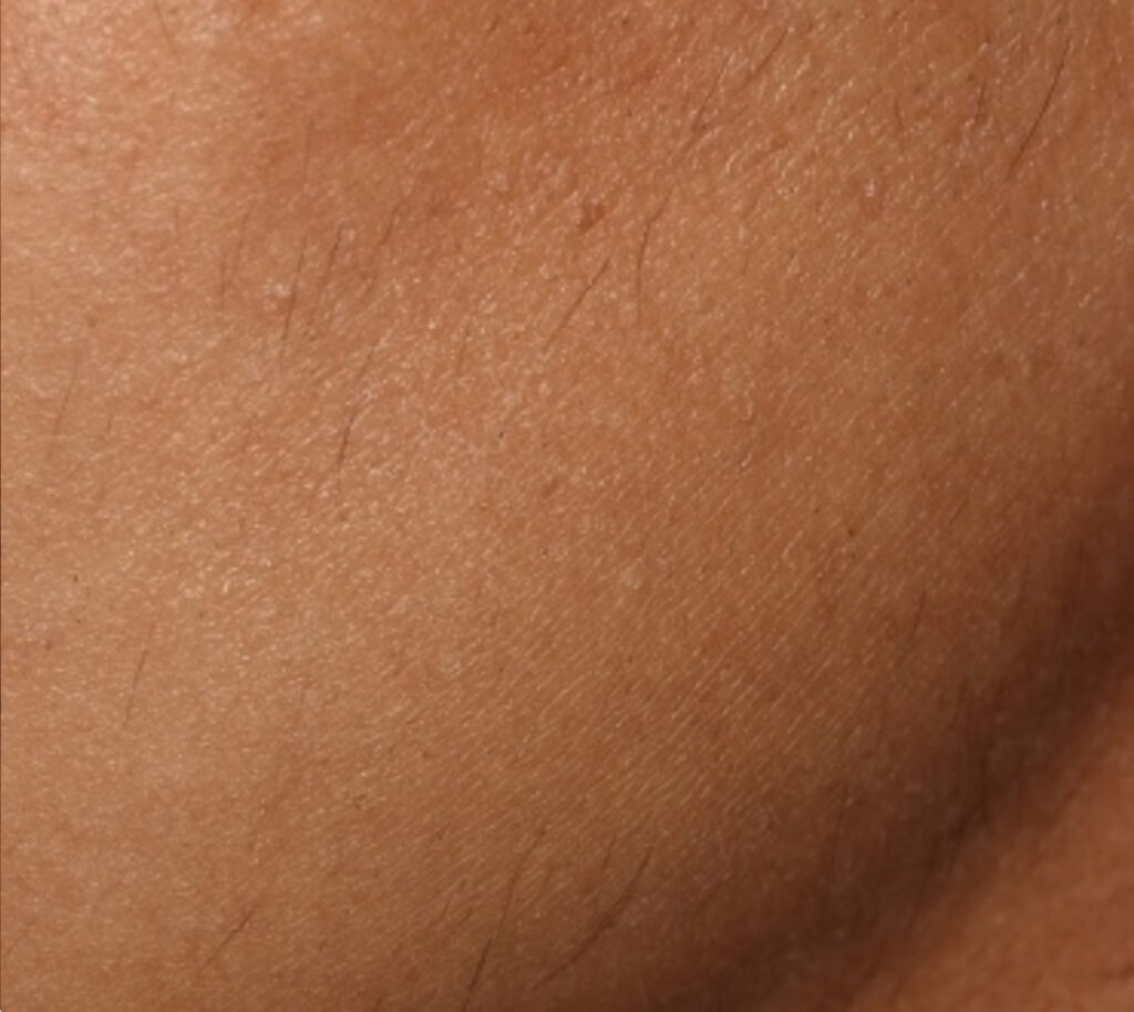 Αποτρίχωση με laser