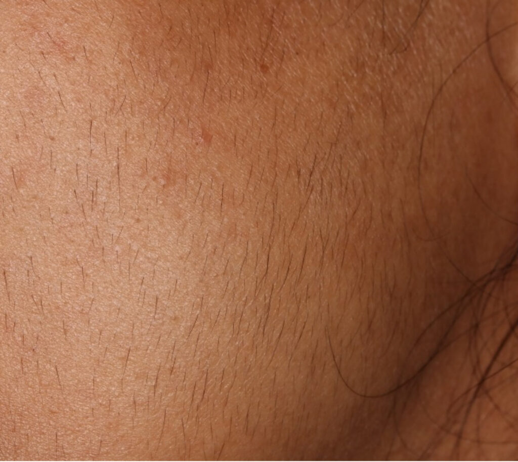 Αποτρίχωση με laser