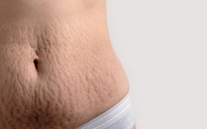 Treatment of stretch marks