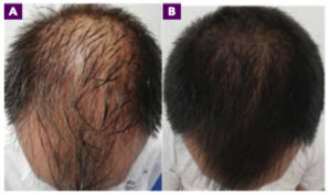 Mesotherapie gegen Haarausfall mit Dutasterid