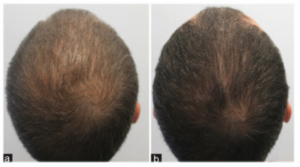 Mesotherapie gegen Haarausfall mit Dutasterid